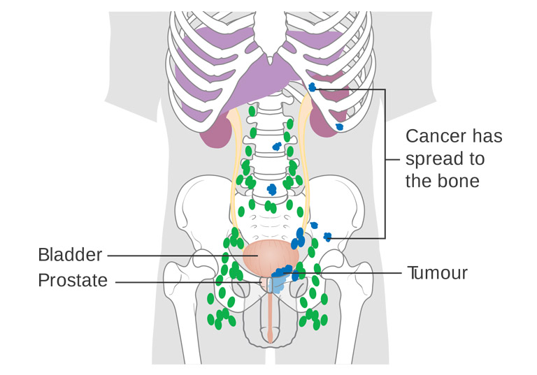 Ung thư tuyến tiền liệt di căn xương