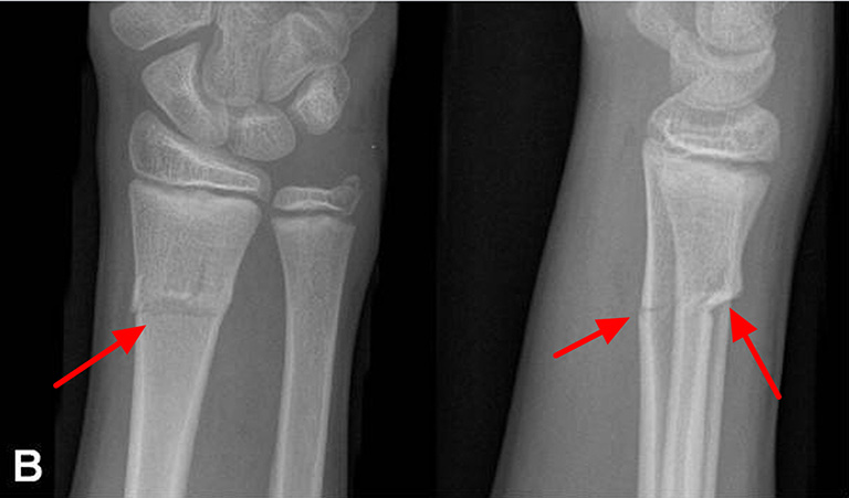 Gãy xương cành tươi được phát hiện thông qua hình ảnh X-quang