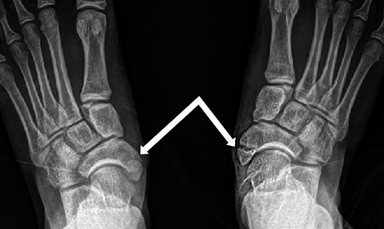 Hình ảnh X-quang cho thấy xương bàn chân bị gãy và di lệch