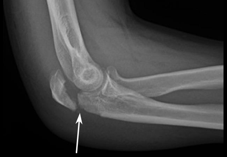 Chụp X-quang khuỷu tay