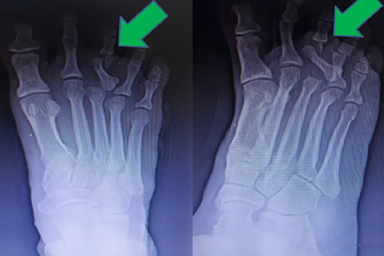Gãy xương ngón chân thường được chẩn đoán phân biệt với trật khớp ngón chân