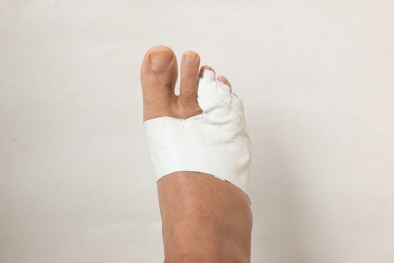Dùng băng gạc y tế cố định ngón chân bị gãy vào ngón chân cận kề