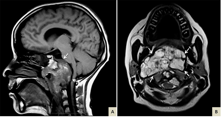 Có thể chẩn đoán xác định u nguyên sống thông qua chụp cộng hưởng từ (MRI)