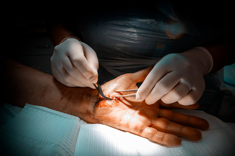 Chi phí mổ hội chứng ống cổ tay từ 2 - 3 triệu đồng đối với mổ mở, 5 triệu đồng đối với mổ nội soi