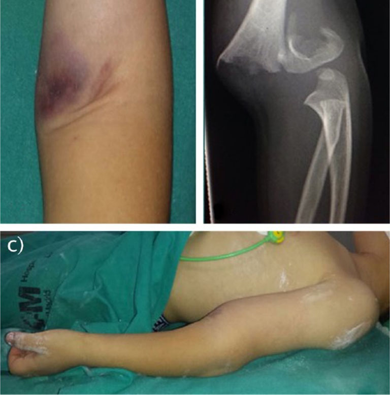 Biến dạng thường liên quan đến gãy trên lồi cầu xương cánh tay không được điều trị đúng cách