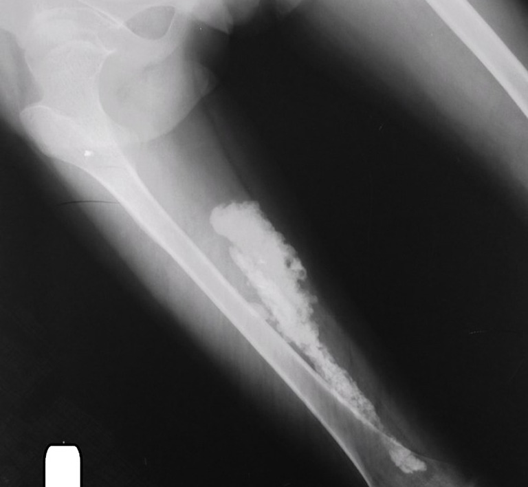 Hình ảnh X-quang ở bệnh nhân bị viêm cơ cốt hóa giai đoạn trưởng thành