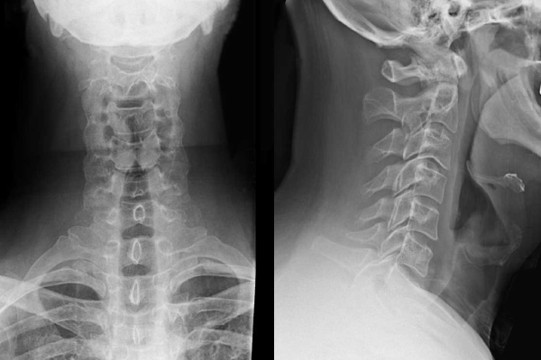 Chẩn đoán thoái hóa cột sống bằng chụp X-quang