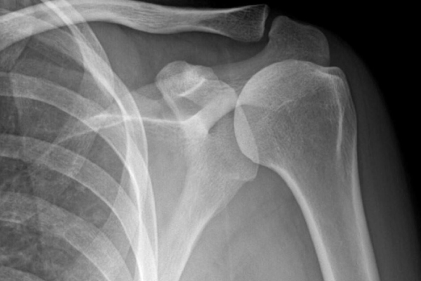 Chụp X-quang giúp phát hiện các tổn thương xương khớp