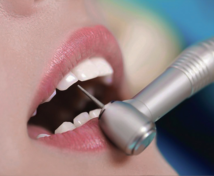 Bọc răng sứ cần mài cùi răng nên có thể gây đau, khó chịu