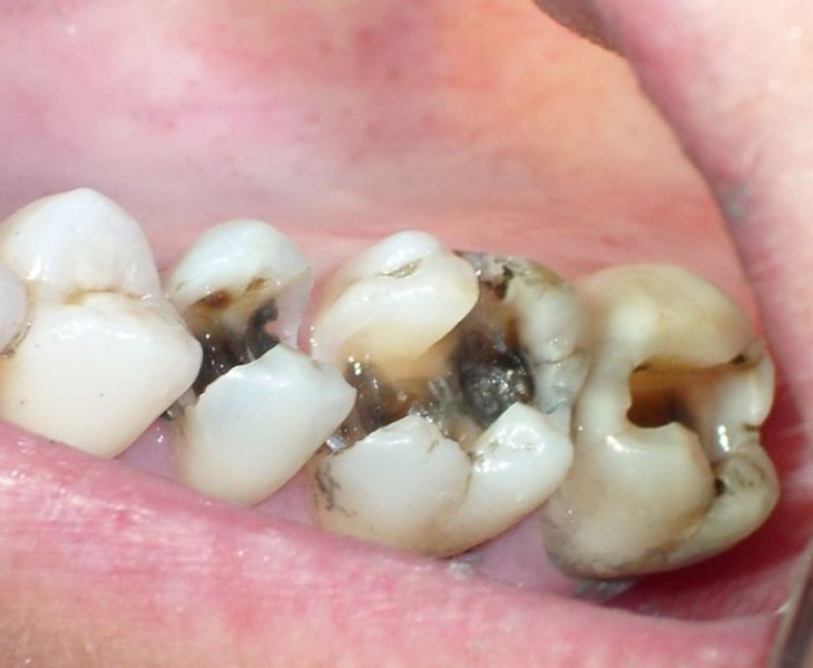 Bọc răng sứ không đúng quy trình có thể gây viêm tủy