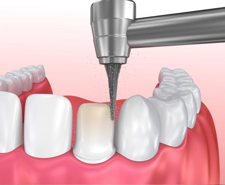 Bọc răng sứ có đau không phụ thuộc vào kỹ thuật mài răng của bác sĩ